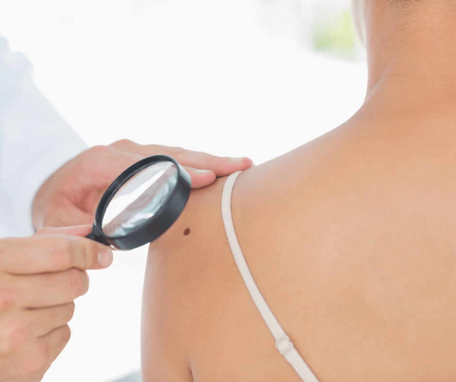Nutrition for Melanoma
